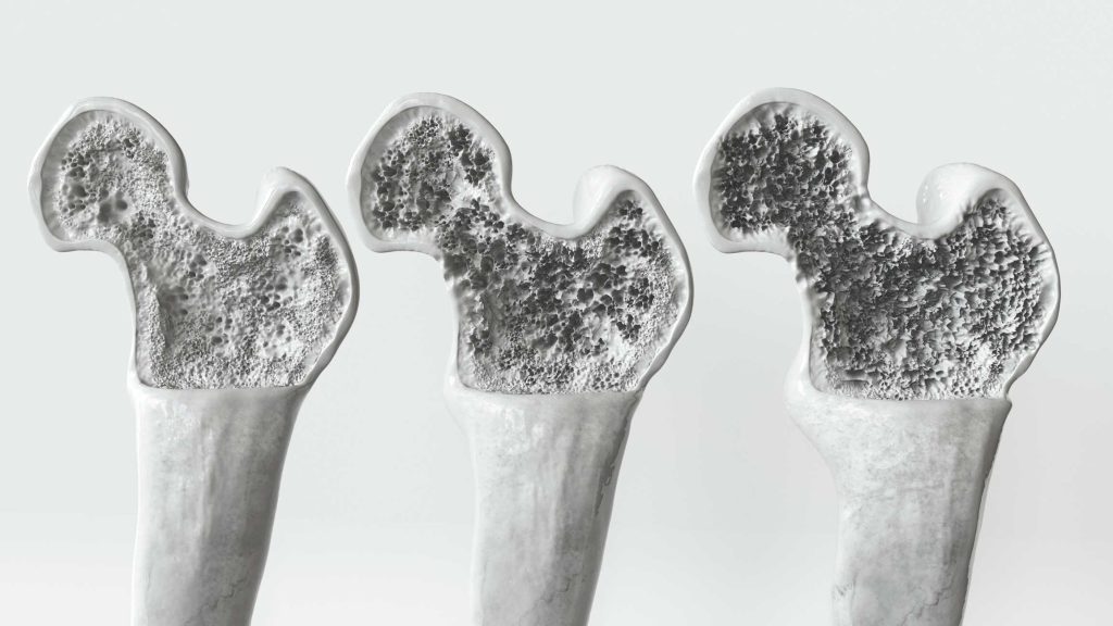 osteoporosis, tratamiento de la osteoporosis, consulta de osteoporosis, experto en osteoporosis.