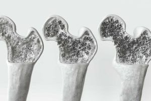 osteoporosis, tratamiento de la osteoporosis, consulta de osteoporosis, experto en osteoporosis.