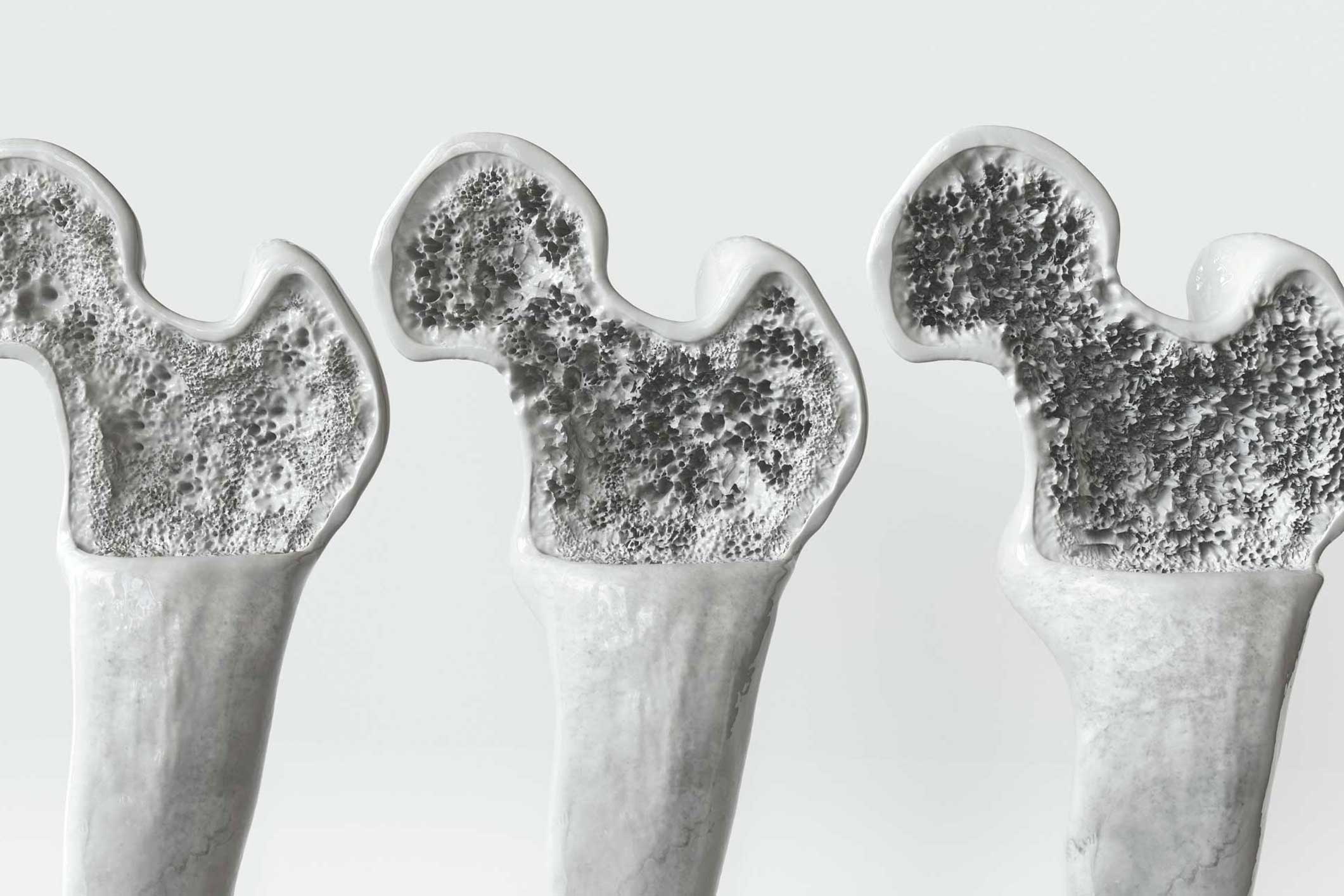 osteoporosis, tratamiento de la osteoporosis, consulta de osteoporosis, experto en osteoporosis.